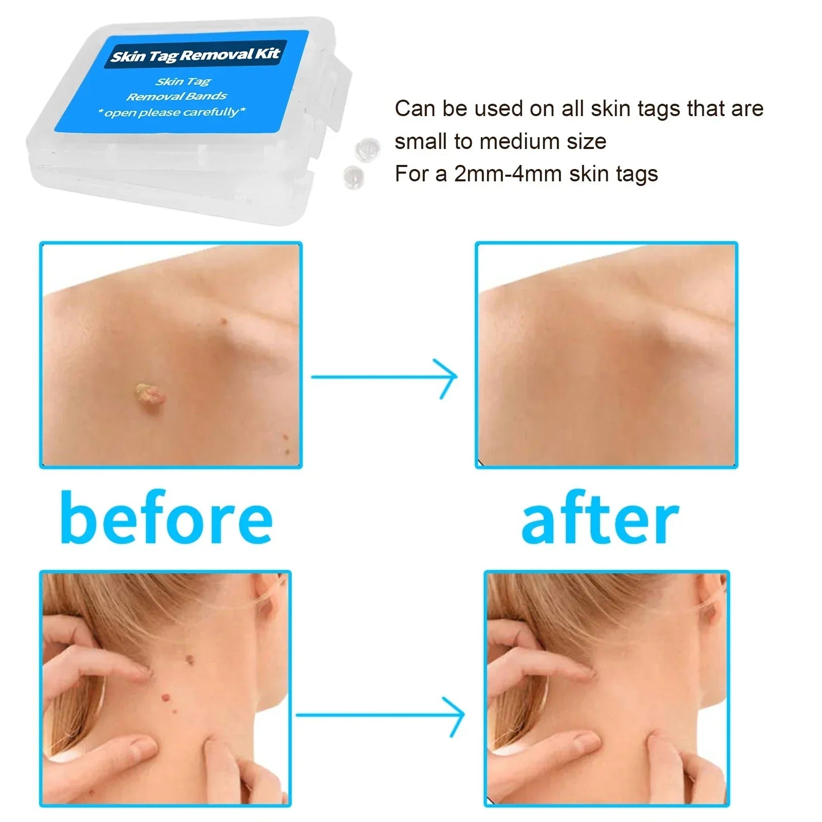 Skin Tag Remover Refill Bands (30pcs)