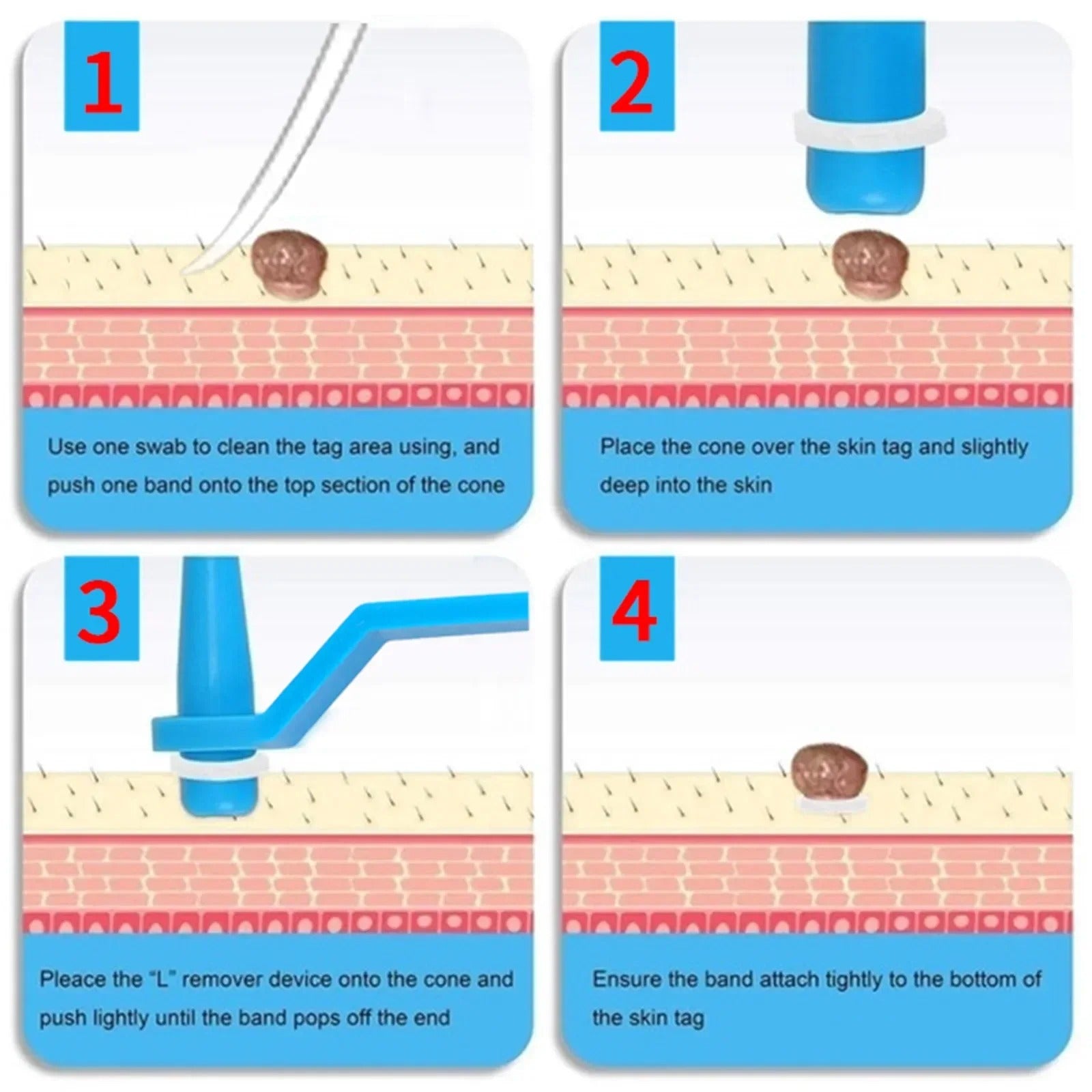 Skin Tag Remover Refill Bands (30pcs)
